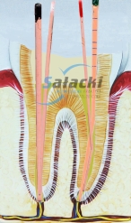 Ząb z wypełnionymi kanałami Endometazonem i wkładami Gutaperkowymi