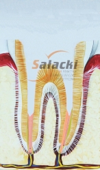 Ząb z opracowanymi kanałami pod wkład koronowo - korzeniowy