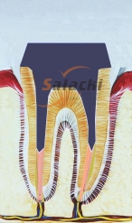 Ząb leczony kanałowo z zacementowanym wkładem koronowo - korzeniowym