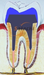 Ząb z zacementowaną koroną protetyczną na wkładzie koronowo - korzeniowym
